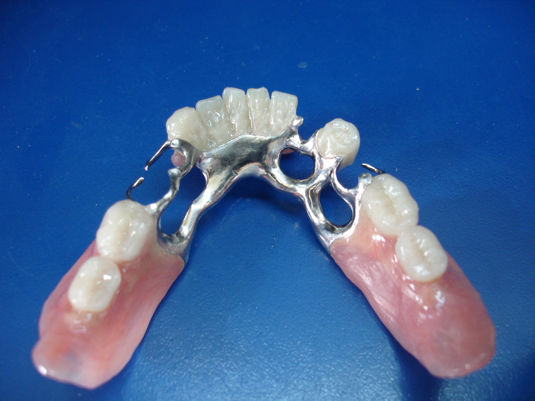 Бюгельный протез зубной на нижнюю челюсть фото